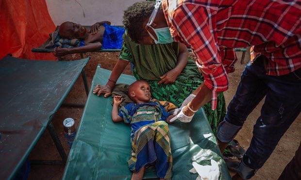 A malnourished Somali child from a refugee camp in the town of Doolow, on the border with Ethiopia, receiving treatment. Photograph: Muse Mohammed/IOM